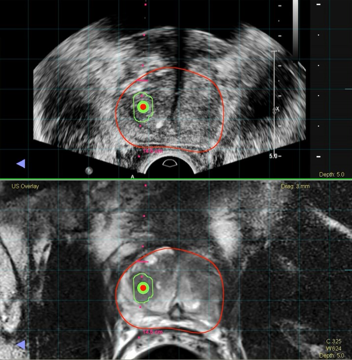 MRI-TRUS Fusion