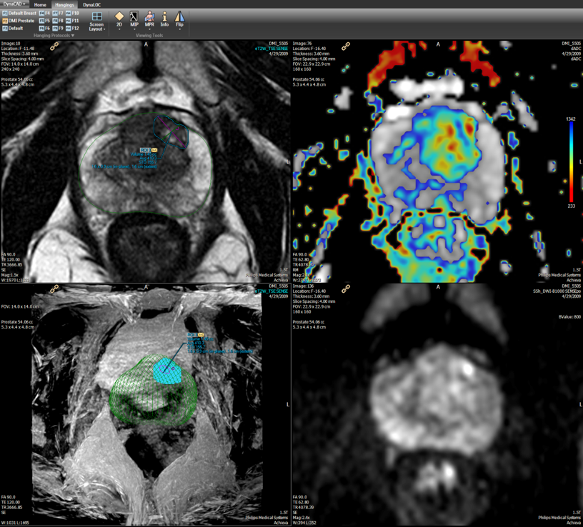 Hatalmas előrelépést jelenthet a multiparametrikus MRI a prosztatarák diagnosztizálásában
