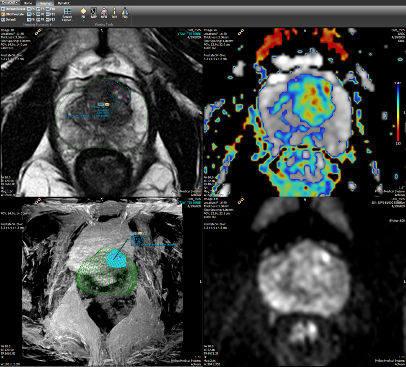 multiparametric mri prostatitis