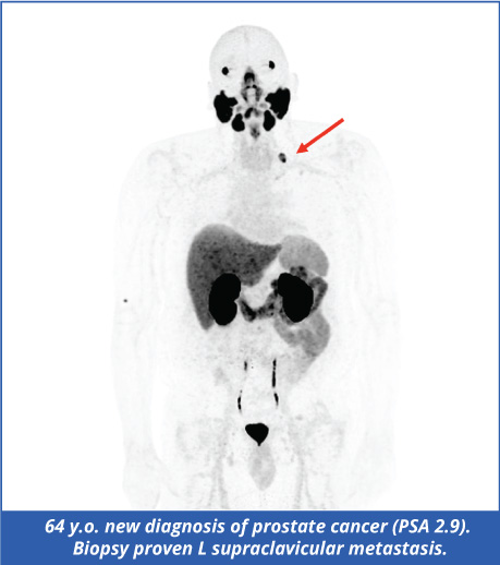 PSMA Scan