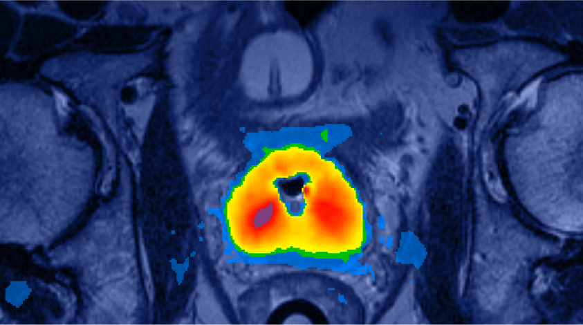 TULSA Procedure vs HIFU